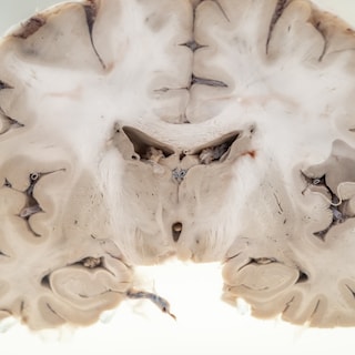 Is an Alzheimer’s drug coming? ‘I am hopeful that we will find something’