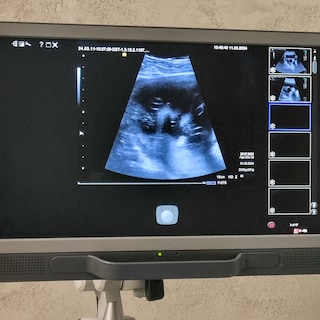 OLVG starts trial for late-term abortions: procedure between 22nd and 24th week is permitted but remains sensitive