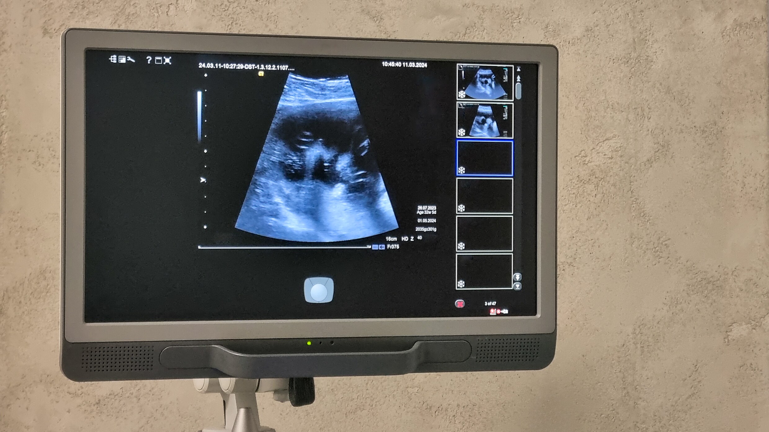 OLVG starts pilot for late-term abortions between 22 and 24 weeks